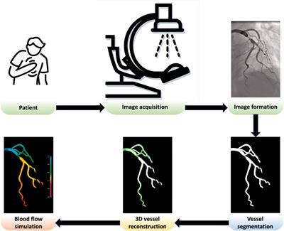 Patient-specific in silico 3D coronary model in cardiac catheterisation laboratories